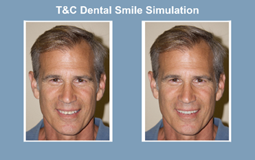Smile simulation process