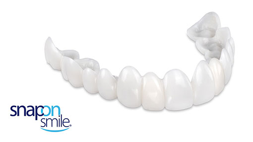 snap on smile veneers