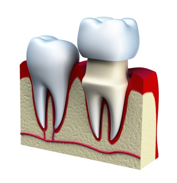 3D rendering of how dental crowns sit on teeth