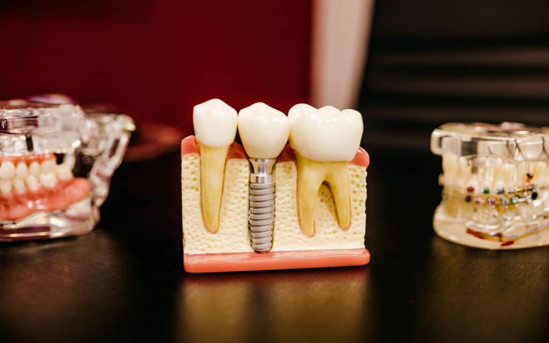 Model displaying how dental implants fit into the jawbone