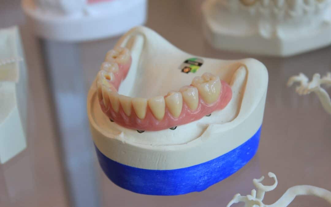 Implant-supported dentures on a dental cast