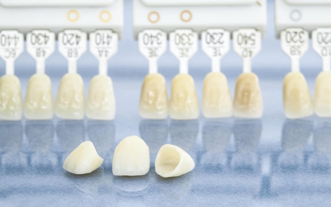 Close-up image of porcelain veneers and a shade guide.