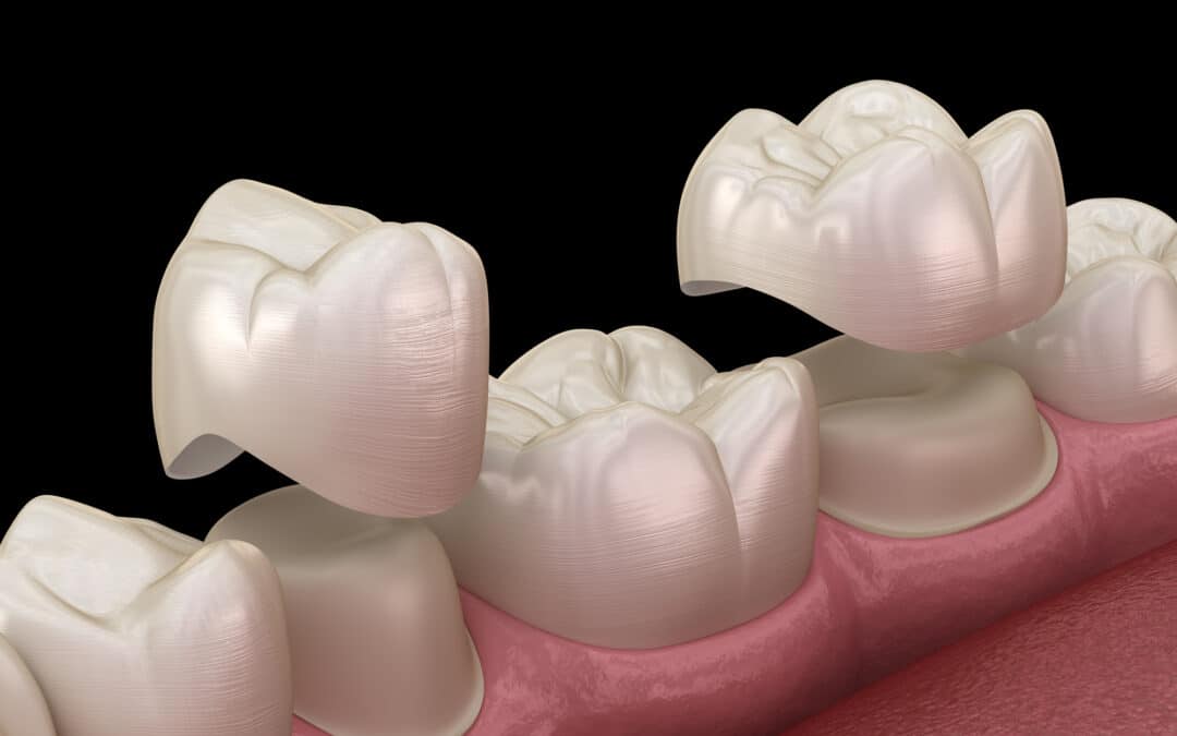 Porcelain crowns placement over premolar and molar teeth. . Medically accurate 3D illustration