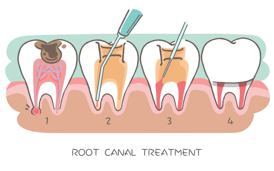 illustration of root canal therapy process