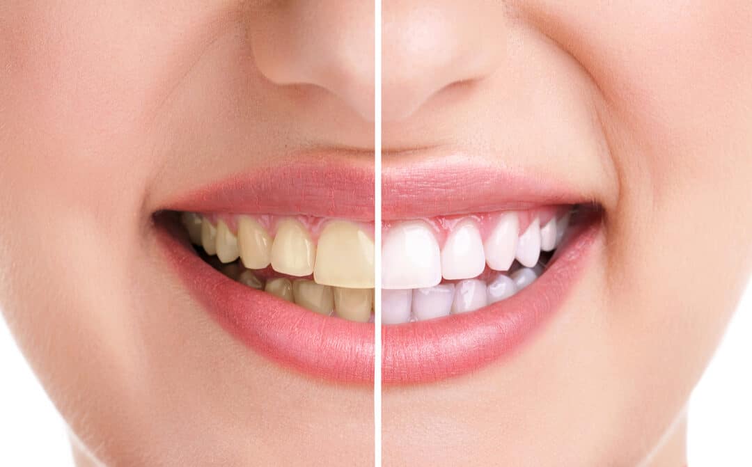 woman teeth and smile, close up, isolated on white, teeth whitening treatment