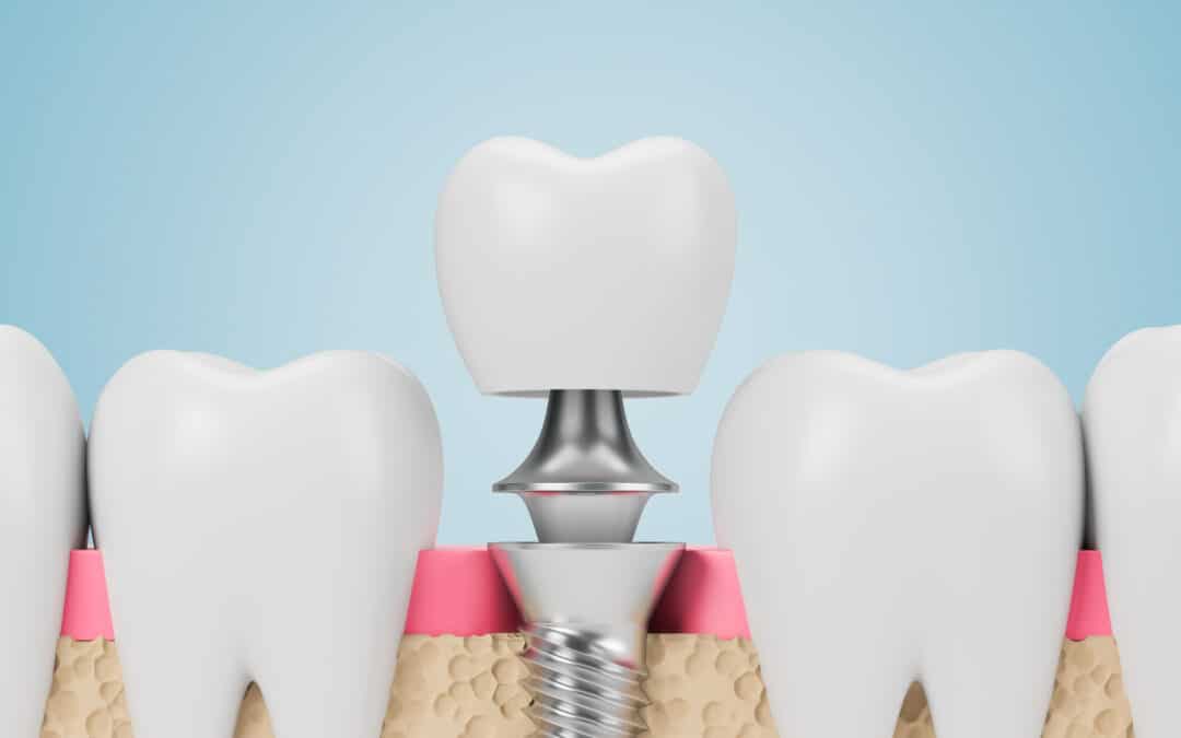 dental implants and crown on blue background