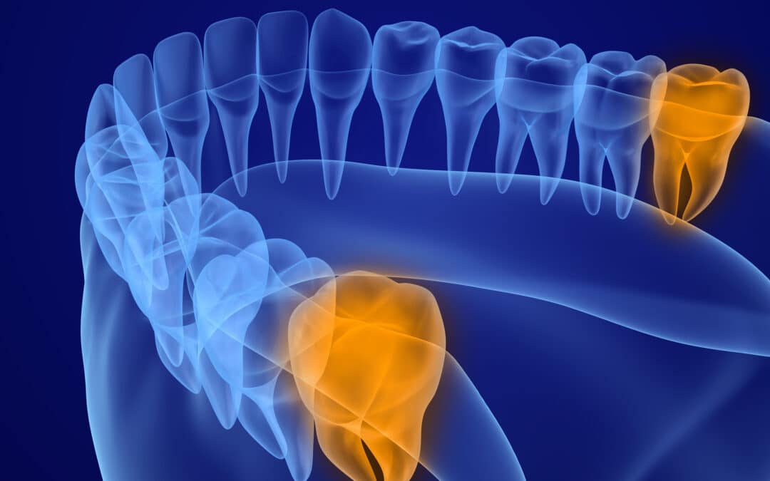 wisdom tooth pain on x-ray