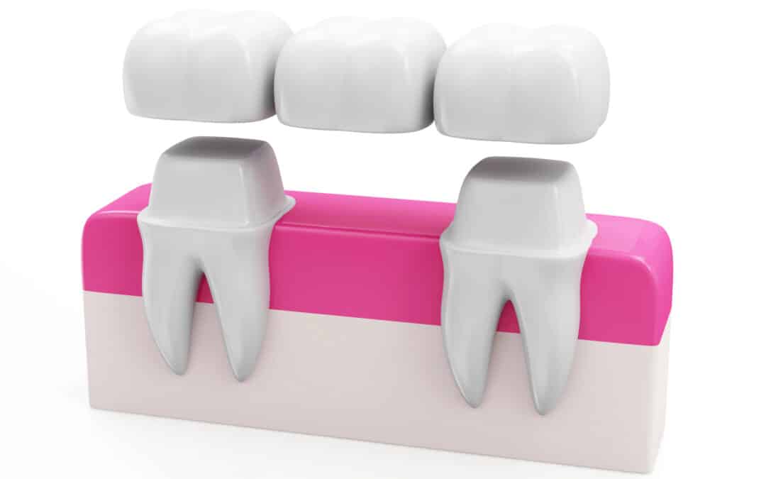 How Dental Bridges Can Transform Your Appearance