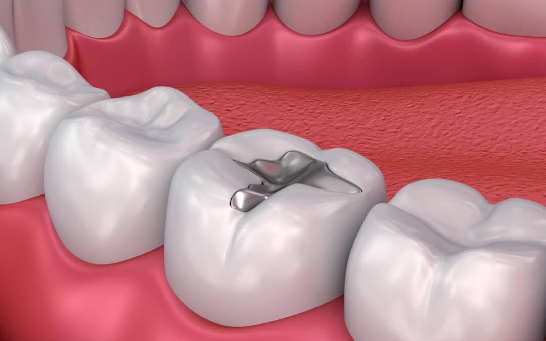 Oak Park Dentist Explores Different Types of Dental Fillings