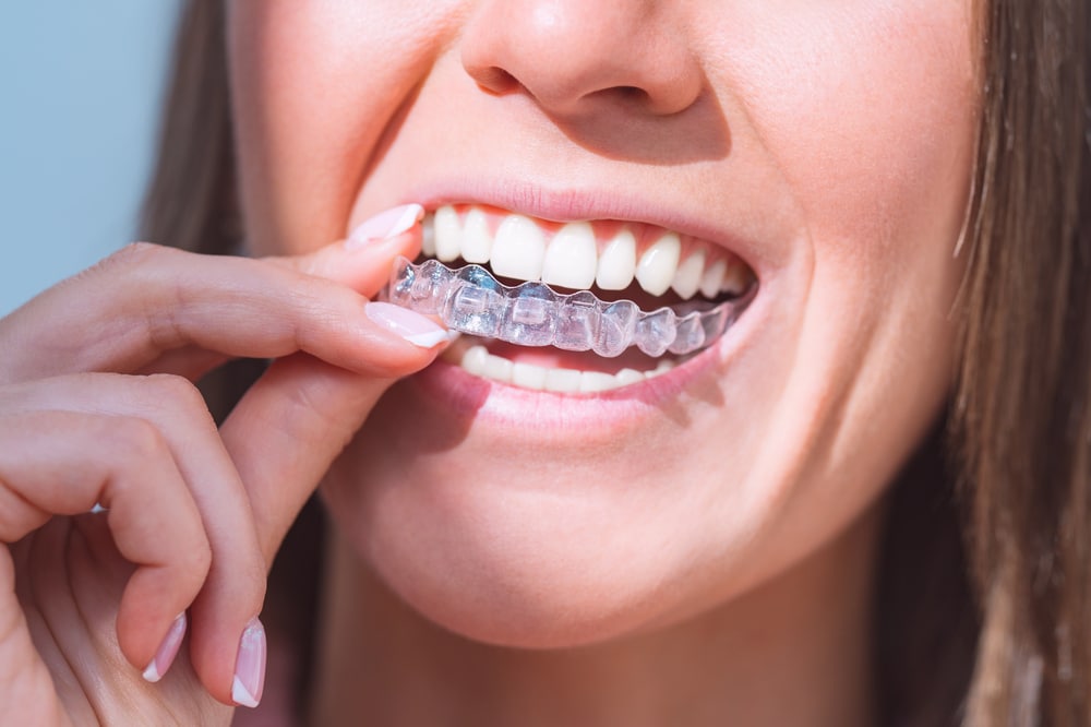 Can Invisalign® Fix Overbites, Underbites, and Crowding?