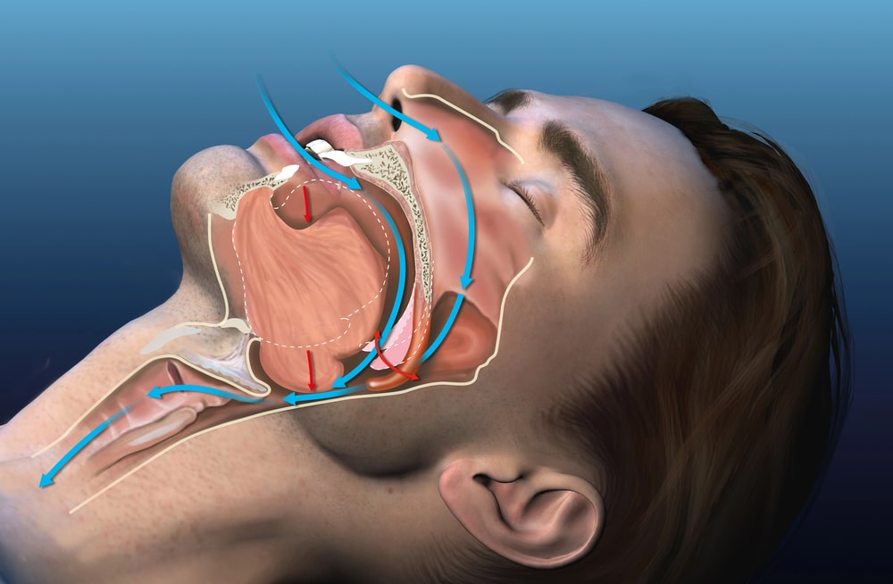 The Link Between Teeth Grinding, Sleep Apnea, and Snoring