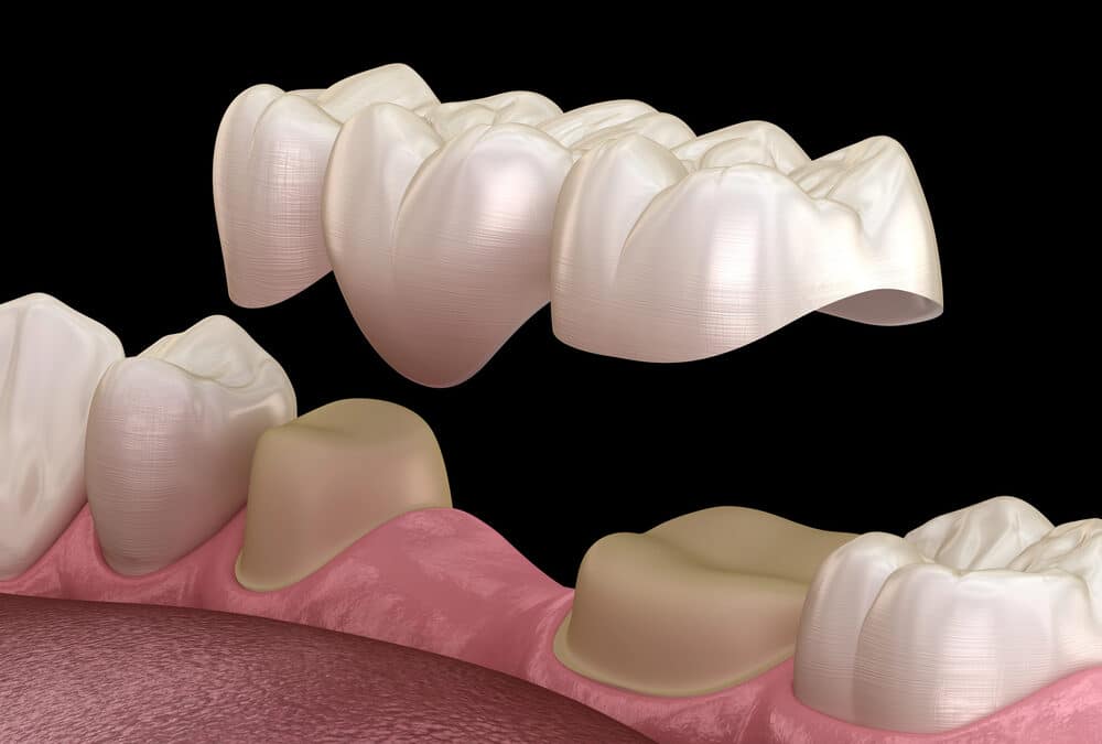 Dental Bridges and Eating: What Foods to Enjoy and What to Avoid