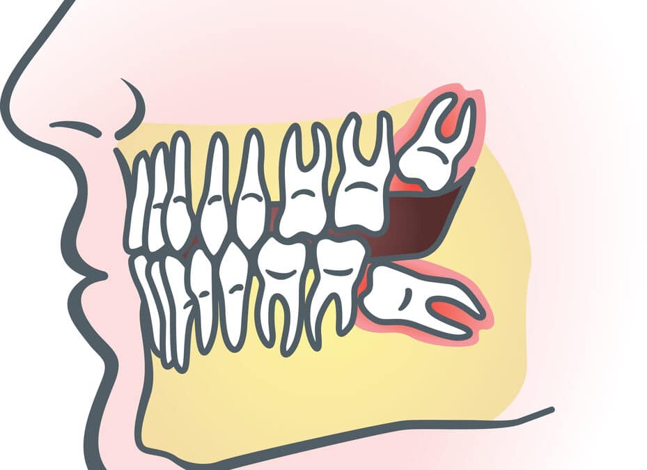 Wisdom Teeth 101: A Guide for Parents and Young Adults