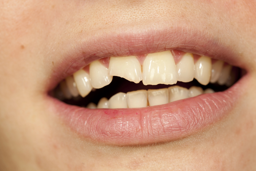 Why Do My Teeth Break So Easily? The Link Between Diet, Stress, and Tooth Damage